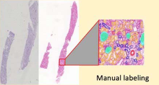 Artificial intelligence in renal pathology: Current status and future