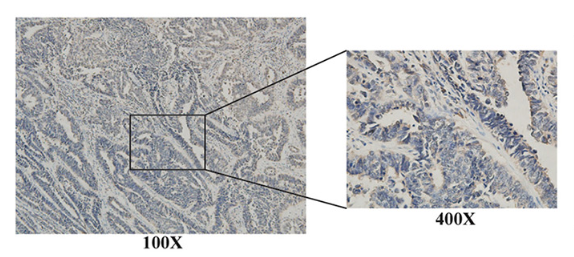 Systemic analysis of the expression and prognostic significance of USP31 in endometrial cancer