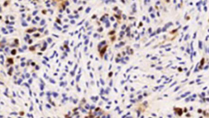 IGHG1 promotes malignant progression in breast cancer cells through the regulation of AKT and VEGF signaling