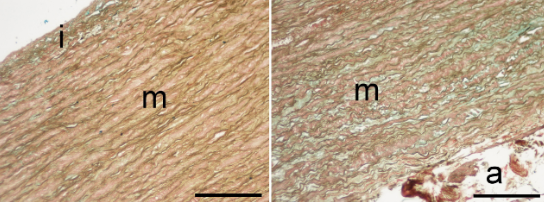 Differences between inflammatory cells infiltrated into tunica intima, media, and adventitia of ascending aortic aneurysms within diabetic and hypertensive patients