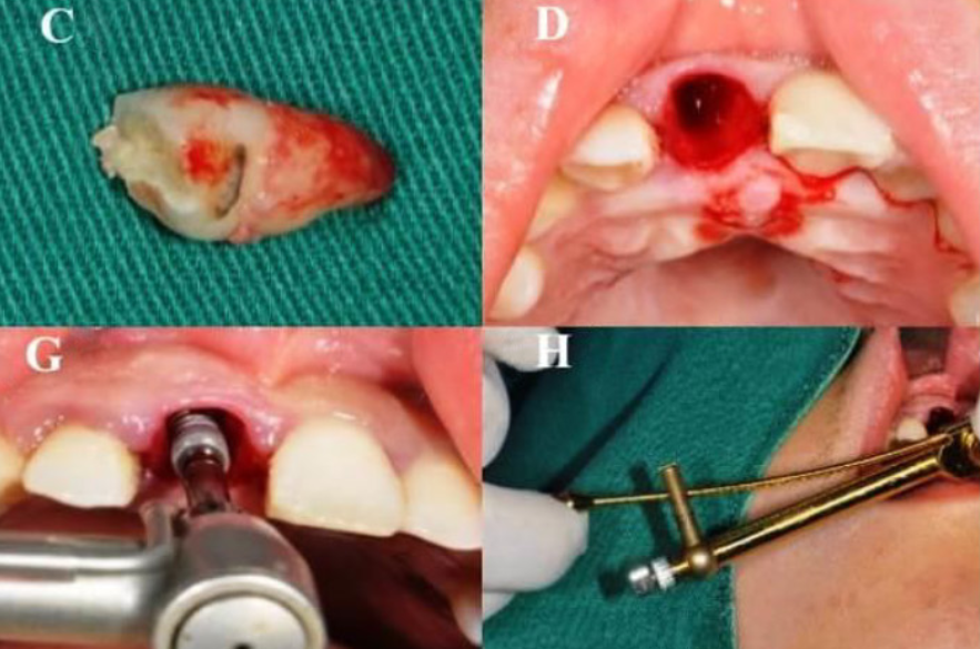 The relationship between labial soft tissue changes and jumping spaces after immediate implant placement and restoration in the anterior maxilla: A prospective study
