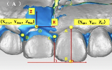 The relationship between labial soft tissue changes and jumping spaces after immediate implant placement and restoration in the anterior maxilla: A prospective study