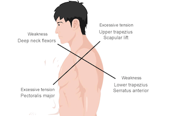 Exploring the latest advancements in physical therapy techniques for treating cervical spondylosis patients: A narrative review