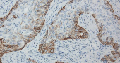 Molecular classification of muscle-invasive bladder cancer based on a simplified immunohistochemical panel using GATA3, CK5/6 and p16