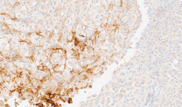 Refining PD-1/PD-L1 assessment for biomarker-guided immunotherapy: A review