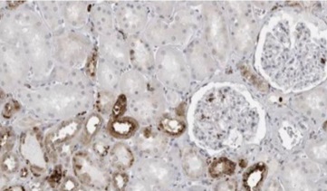 Comprehensive analysis of the role of interferon gamma-inducible protein 30 on immune infiltration and prognosis in clear cell renal cell carcinoma