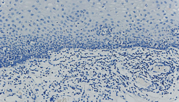 Prognostic significance and immunological role of HPRT1 in human cancers