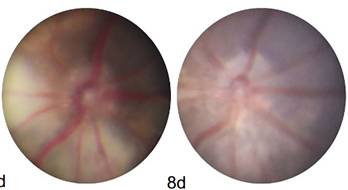The protective effect of DNase I in retinal vein occlusion