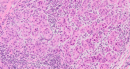 The assessment of tumor-infiltrating lymphocytes in invasive apocrine carcinoma of the breast in relation to the HER2 status