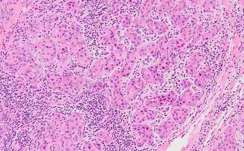 The assessment of tumor-inltrating lymphocytes in invasive apocrine carcinoma of the breast in relation to the HER2 status