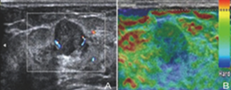 The value of elastography strain rate ratio in benign and malignant BI-RADS-US 3-4 breast masses