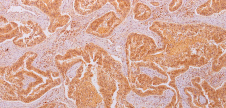The role of the NY-ESO-1 in the prognosis of gastric cancer