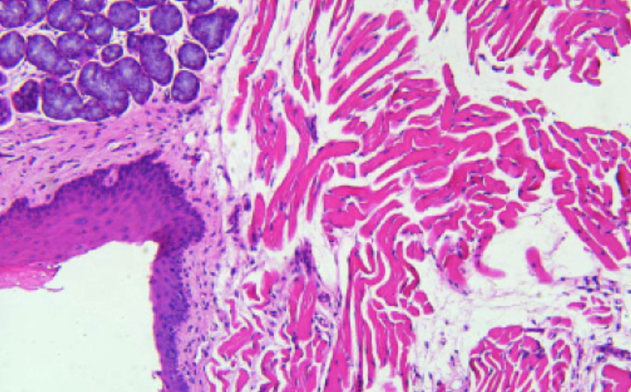 Adipose tissue-derived stromal cell-extracellular vesicles ameliorate oral submucous fibrosis by blocking the TGF-β1/Smad3 pathway via the miR-760-3p/IGF1R axis